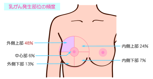 痛み 乳がん 初期