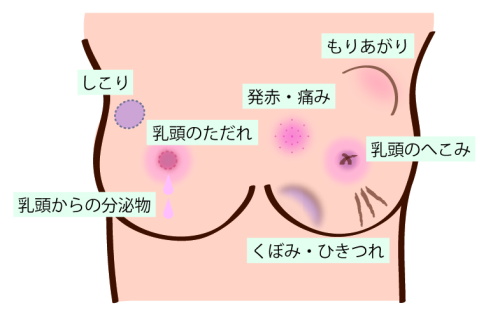 乳がんの症状　しこり　乳頭分泌　皮膚のひきつれ