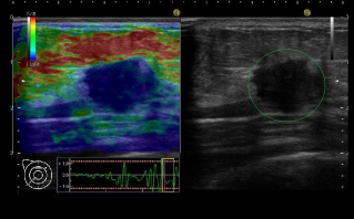乳がんのエラストグラフィ