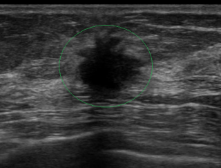 US　乳がん腫瘤像