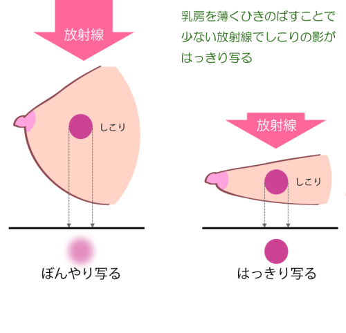 マンモ撮影時の乳房圧迫の意味